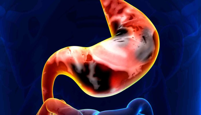 Antibody-based Therapy to Combat Stomach Cancer