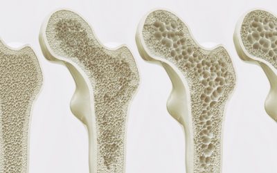 Going Beyond Calcium for Osteoporosis